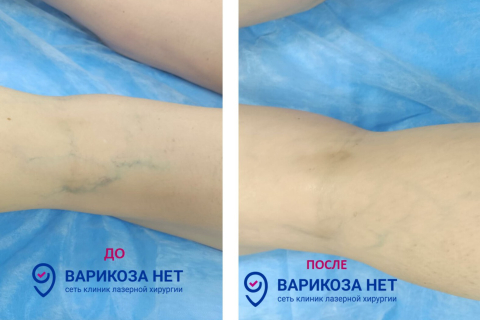 Удаление сосудистых звездочек